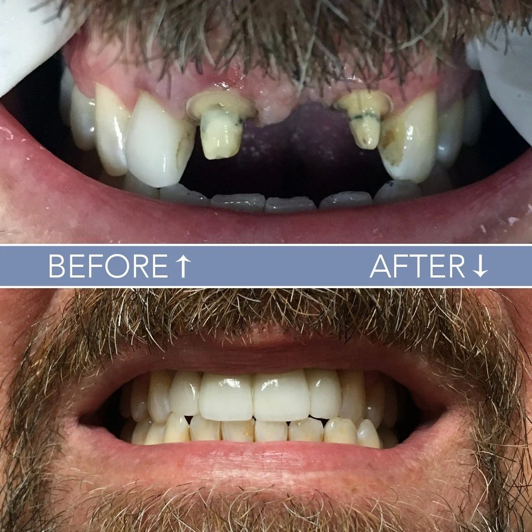 Introducing a fresh chapter of joy with a brand new smile! ✨ Take a look at this stunning upper anterior bridge work, expertly crafted by Dr. V, transforming teeth #s 8-10 into a masterpiece of dental artistry. 😍 

Ready to embark on your own smile 