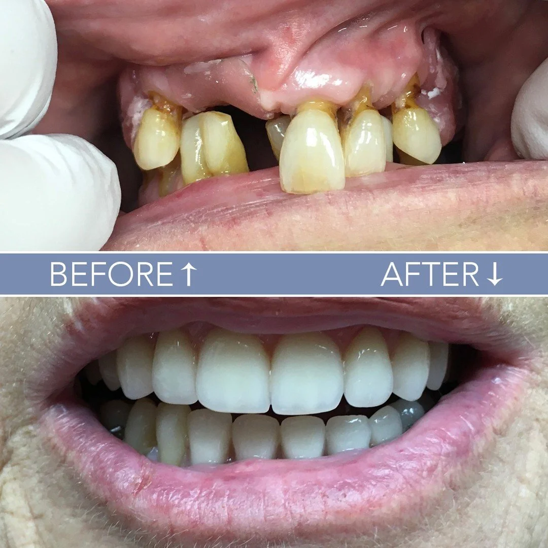 Check out this amazing before and after! 😍 We're thrilled to share the incredible smile makeover of one of our patients. Witness the power of dentures in restoring confidence and transforming lives! ✨

Say goodbye to insecurities and hello to a bran