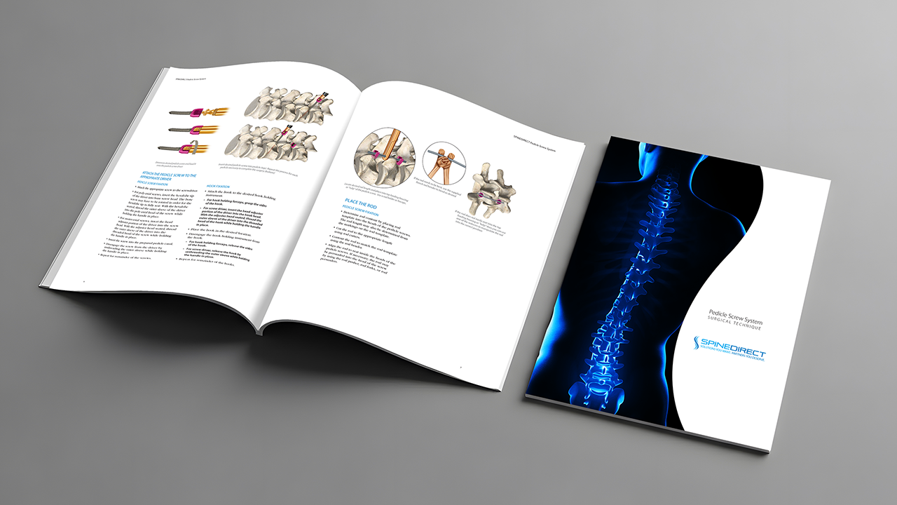 A brochure displaying spinal surgery techniques, including diagrams of vertebrae and surgical tools, with an image of a glowing blue spine on the cover.