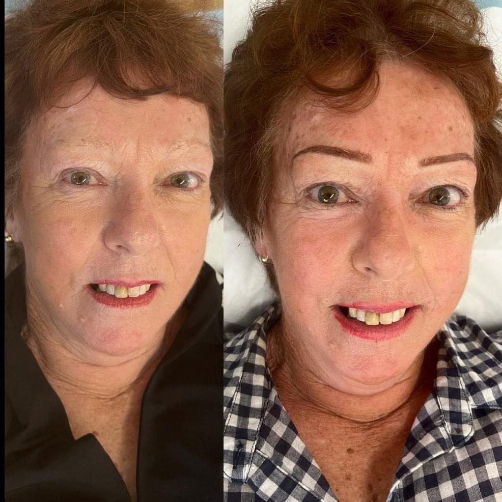 Side-by-side before and after photos of a woman with red hair and fair skin, showing her smiling in both images. In the before photo, she wears a dark top, and in the after photo, she wears a checkered shirt.