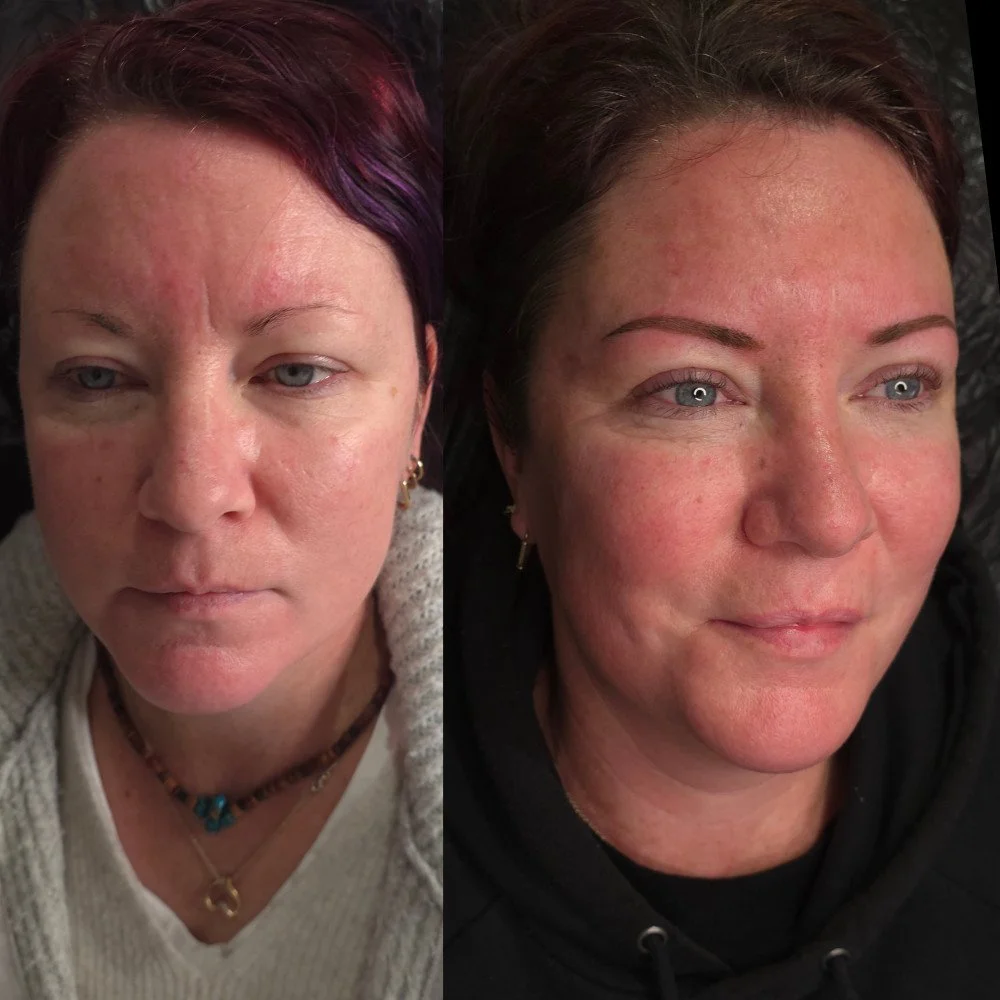 Before and after facial treatment Numurkah