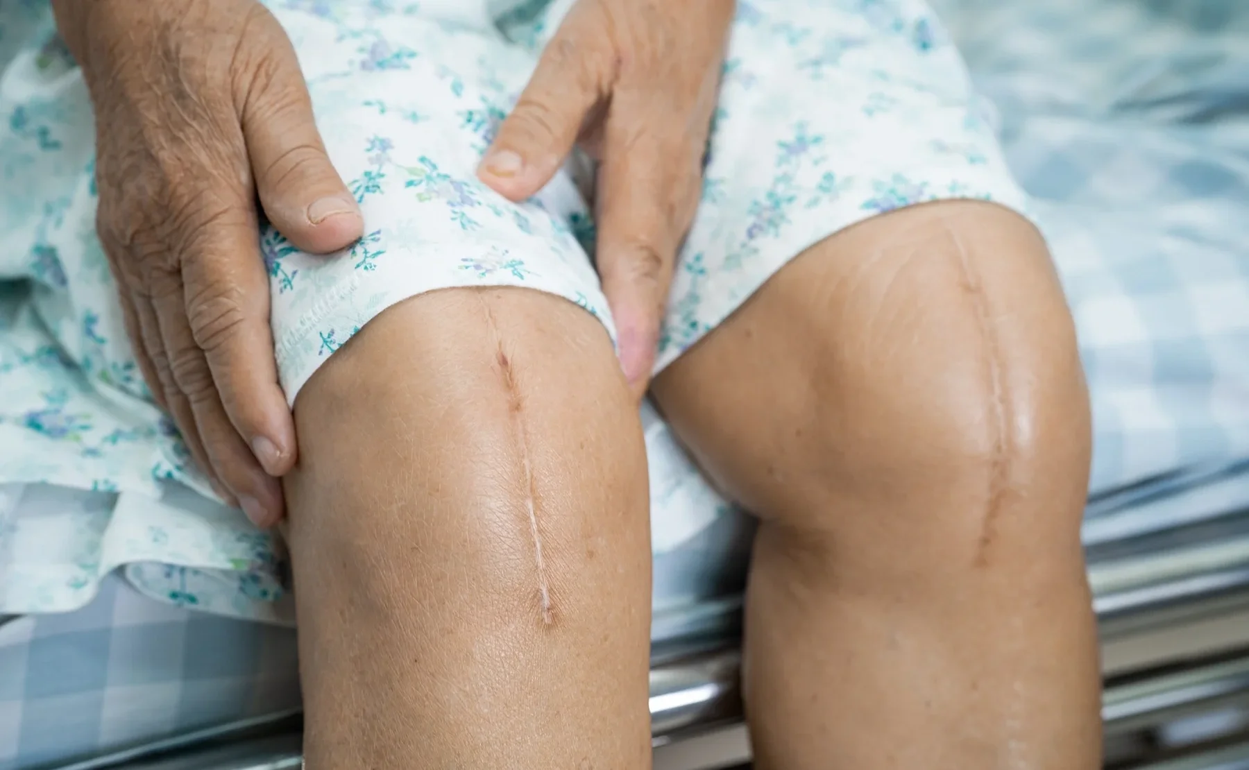 Gentle scar therapy for healed surgical scar tightness and movement restriction