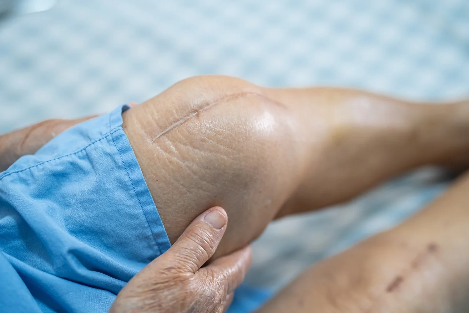 Close-up of a leg scar, representing scar tissue therapy and mobility support in Nelson.