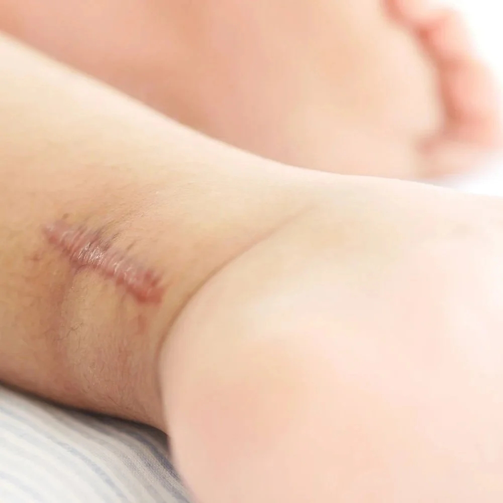 Close-up of a surgical scar near the ankle, representing scar therapy and post-surgery recovery support in Nelson.