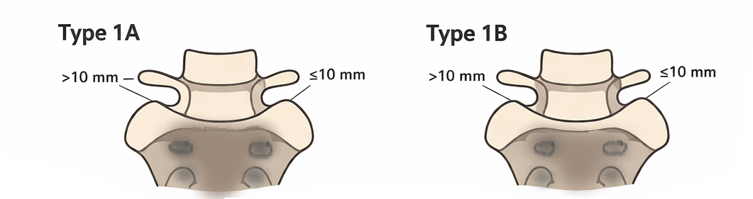 LSTV Jenkins Classifications Type 1