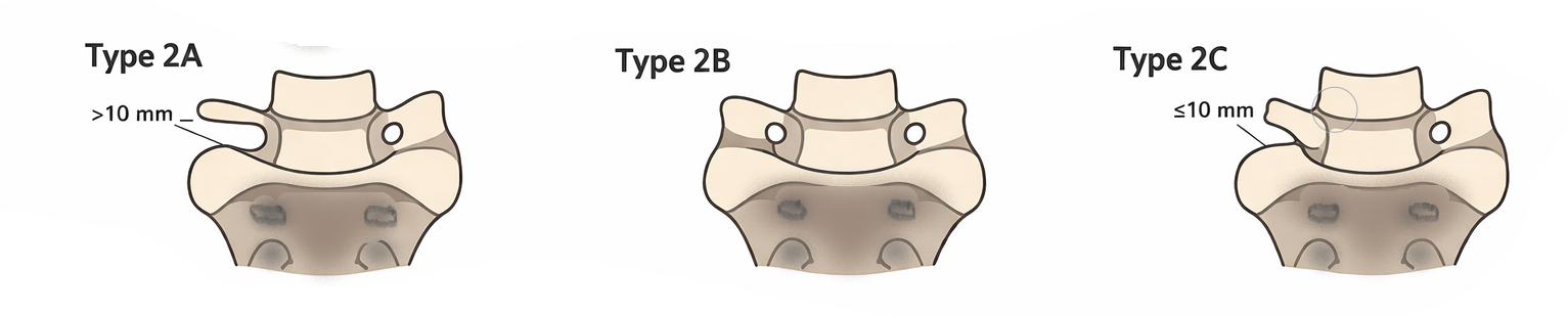 LSTV Jenkins Classifications Type 2