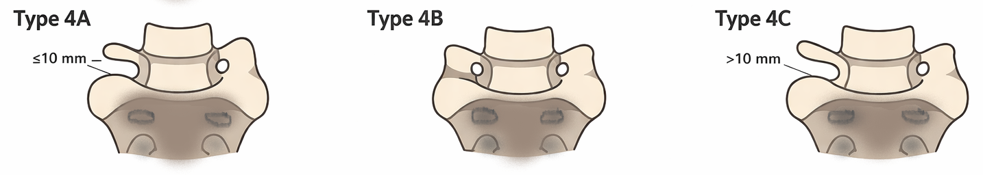 Diagram of three types of cervical vertebral fractures, labeled Type 4A with fractures less than 10mm, Type 4B with fractures of unspecified length, and Type 4C with fractures greater than 10mm.