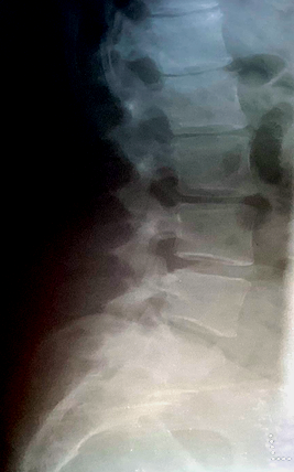 side view of LSTV Lumbosacral Transitional vertebra