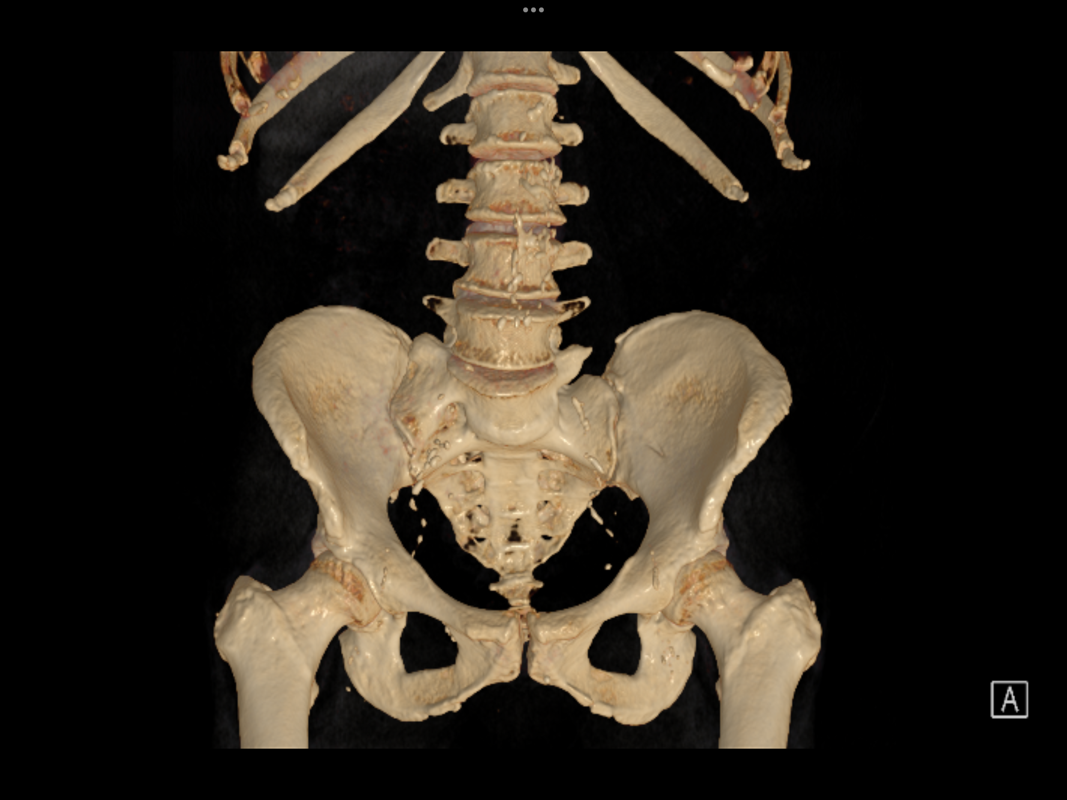 front view lumbar spine T11 Riblet