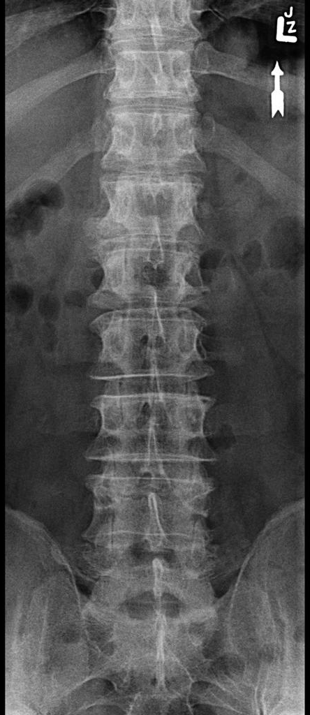 X-ray image of the lumbar spine and pelvis.