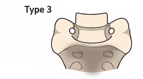 LSTV Jenkins Classification Type 3