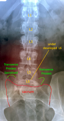 Lumbosacral Transitional Vertebra Xray