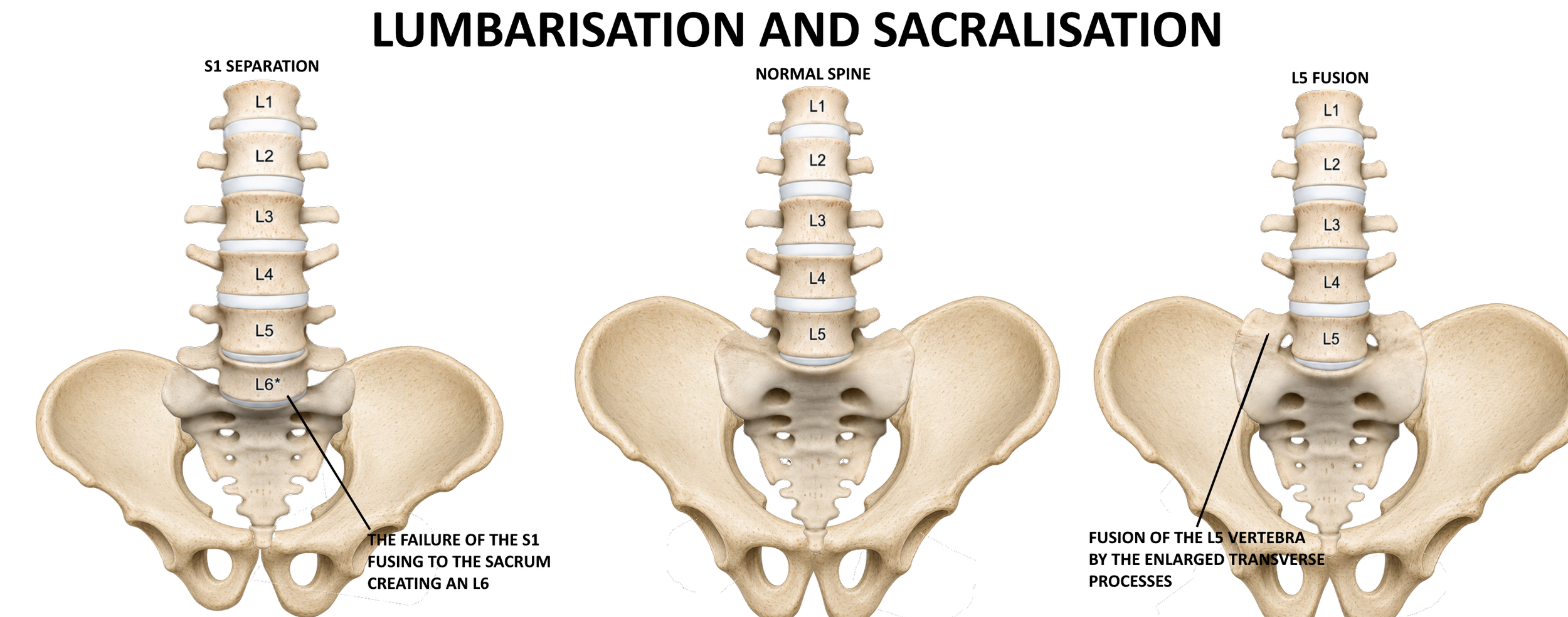 lumbarisation and sacralisation LSTV