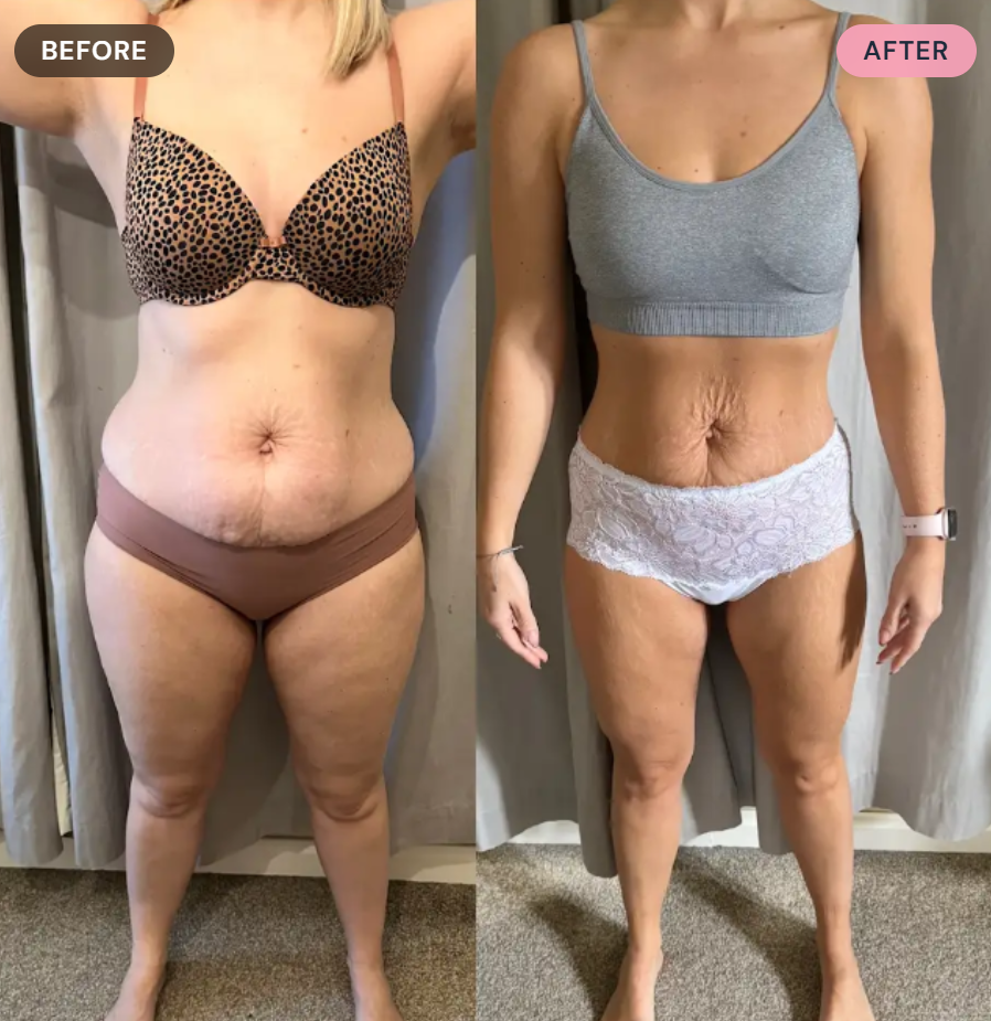 Before and after photos of a woman's torso showing weight loss and skin tightening. In the "before" photo, she wears a leopard print bra and brown underwear. In the "after" photo, she wears a gray crop top and white lace underwear.