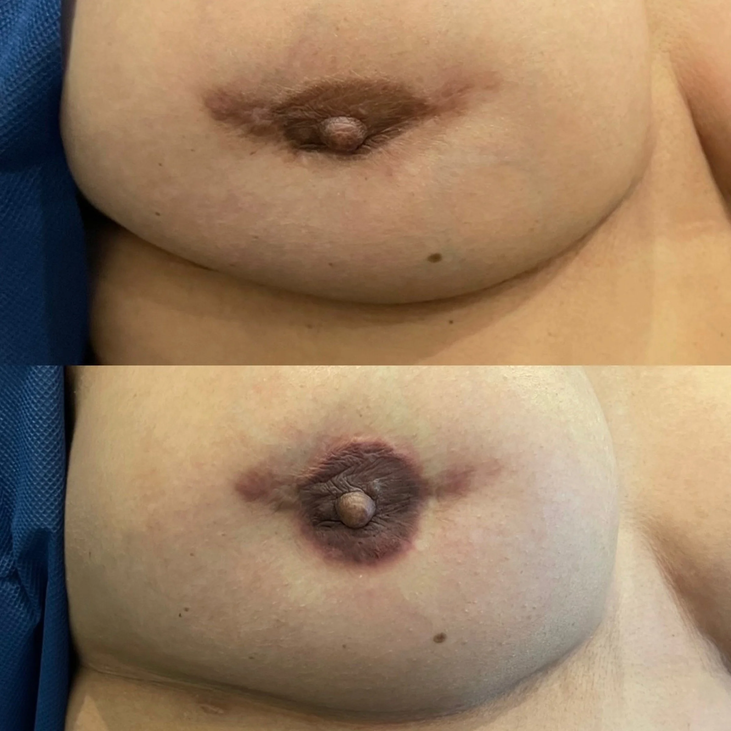 Close-up of a person's nipple and areola on bare skin after tattoo