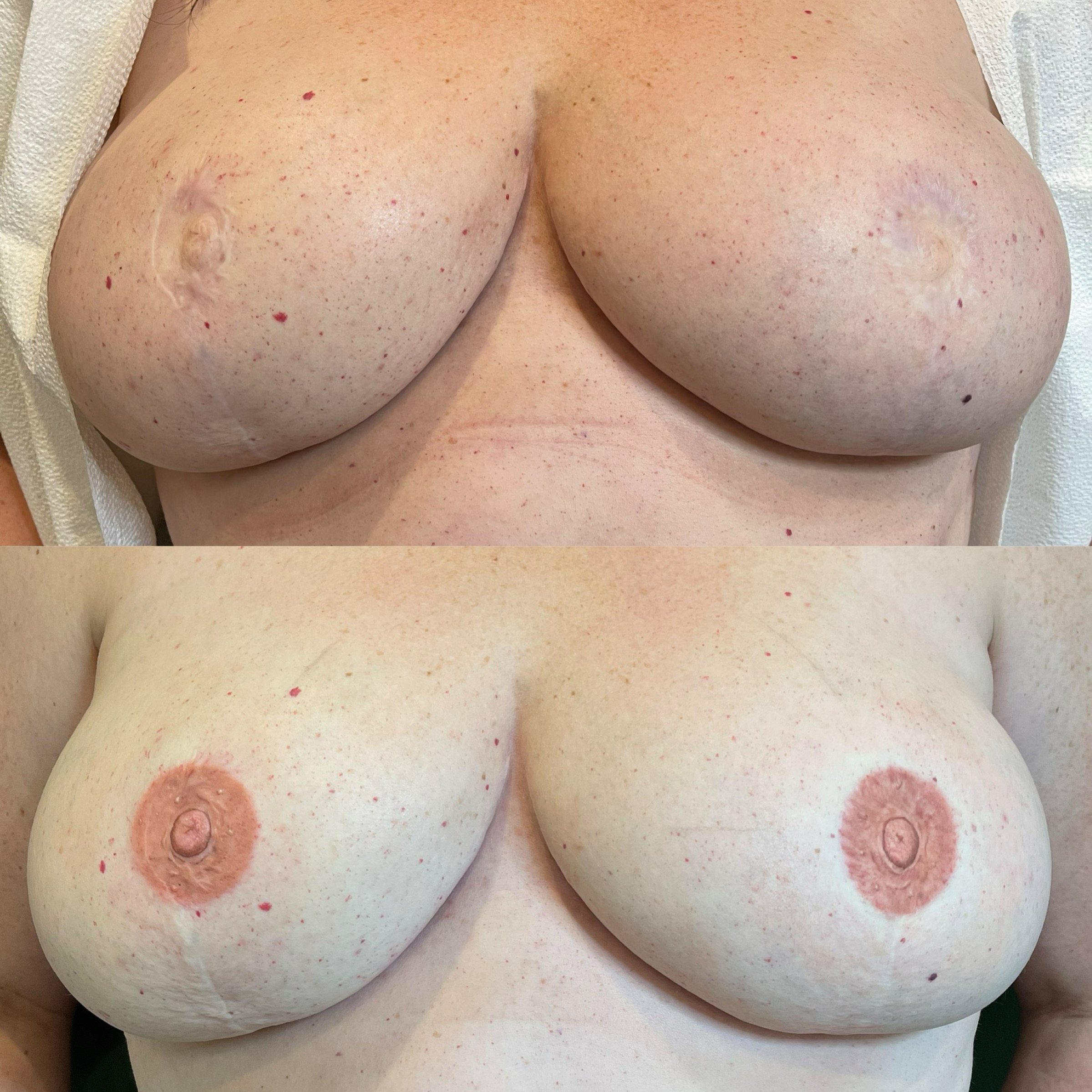 Close-up of a person's bare chest after receiving 3D nipple areola tattoo in Chicago