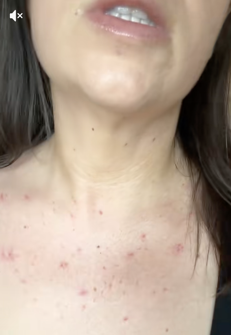 Spider Angiomas