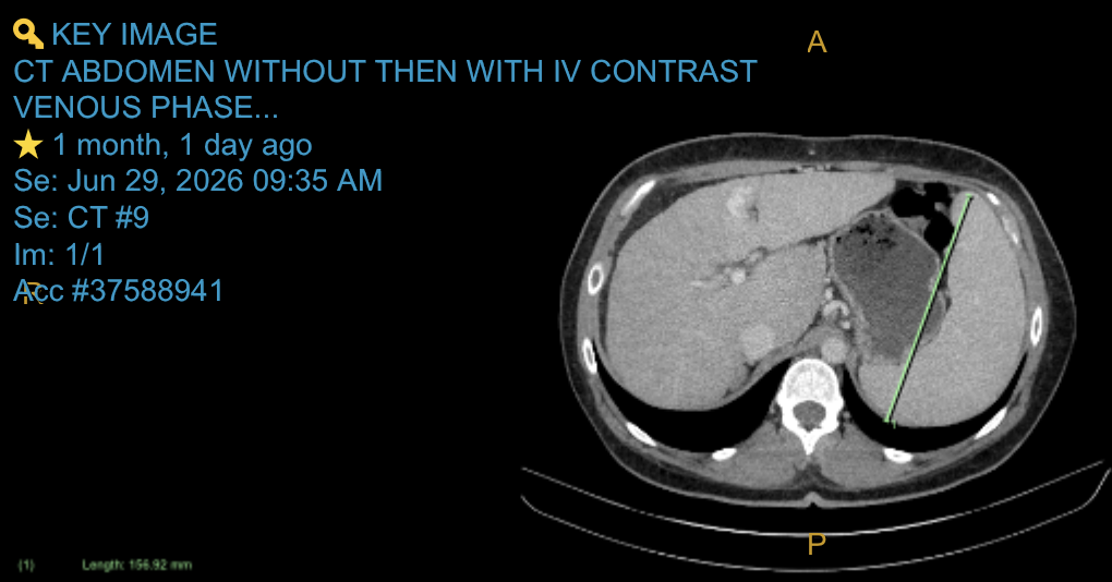 Angie from @diagnosis_cirrhosis shares an example CT Scan image with enlarged spleen