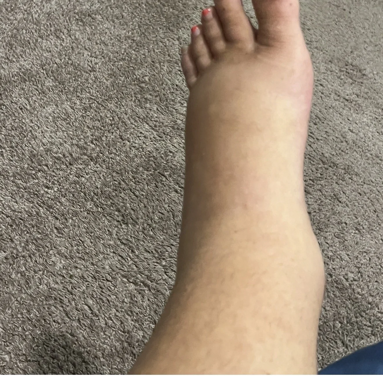 Angie showing the physical signs of peripheral edema and leg swelling caused by low serum albumin levels.
