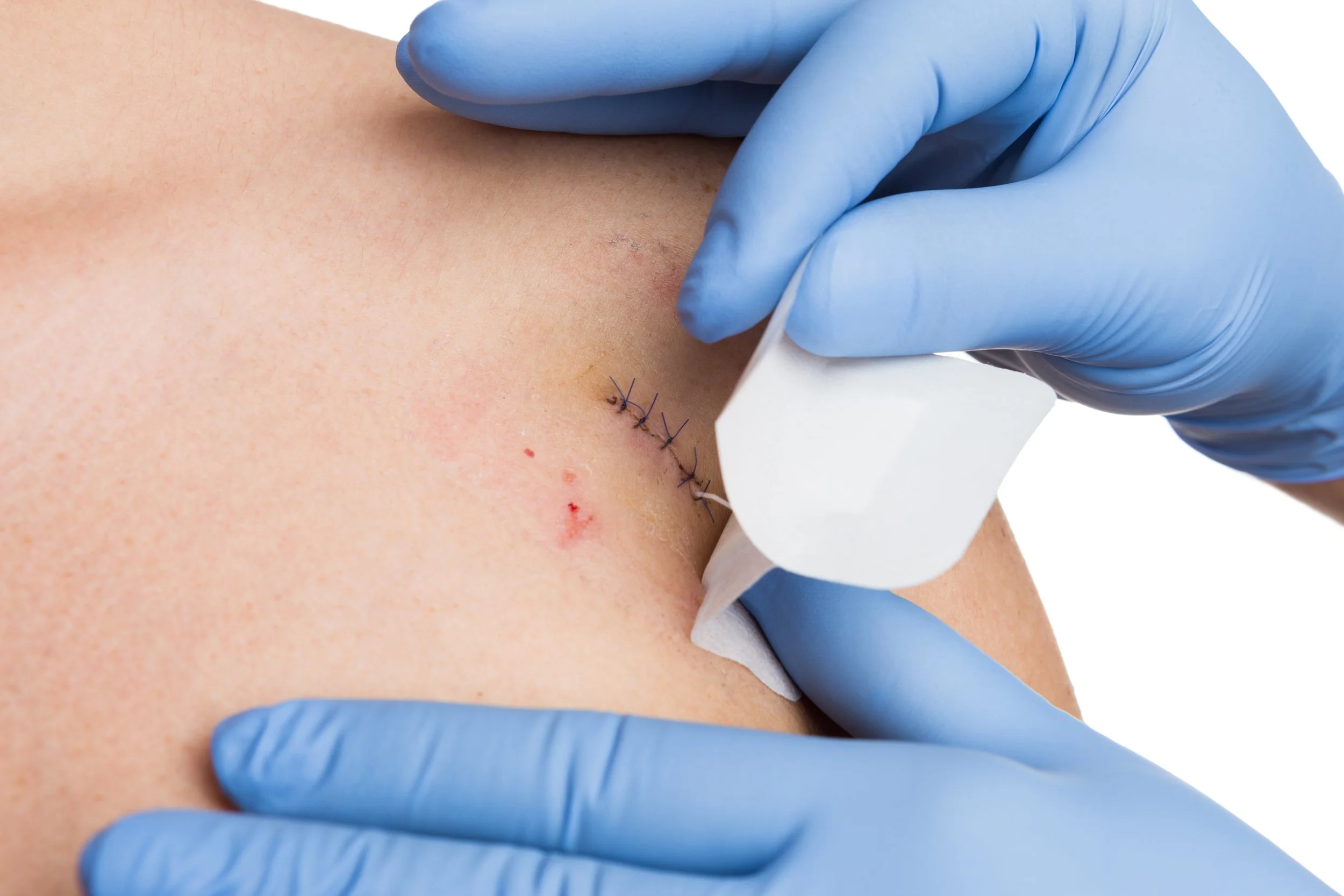 Doctors hands alongside stitches in the skin