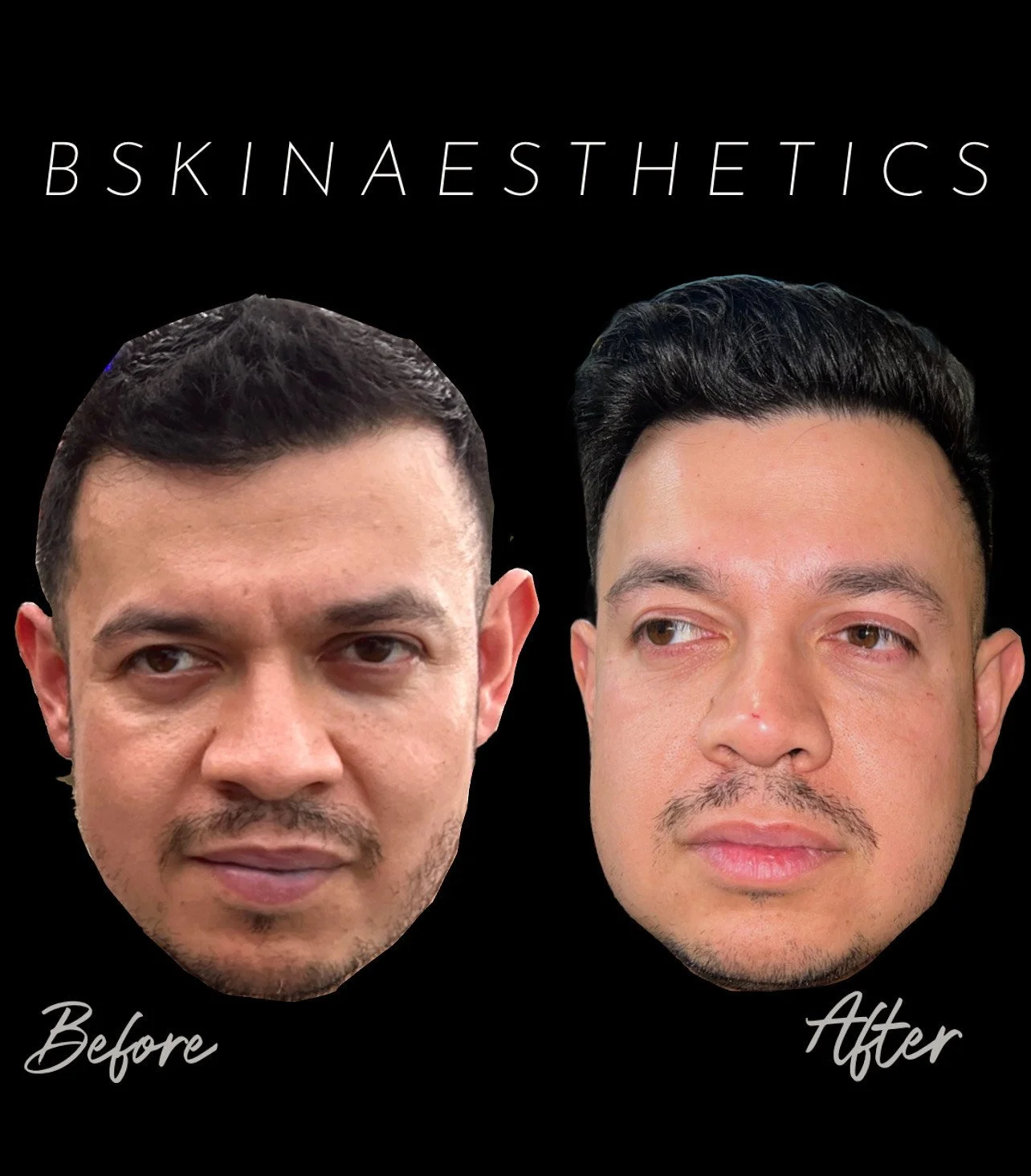 Botox, Nose, Tear Through