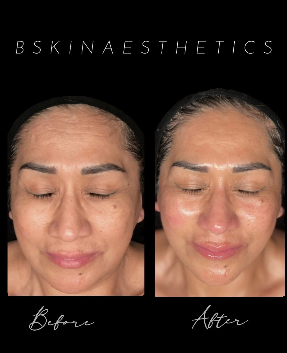 Post Advanced Facial Treatment | Aging Treatment