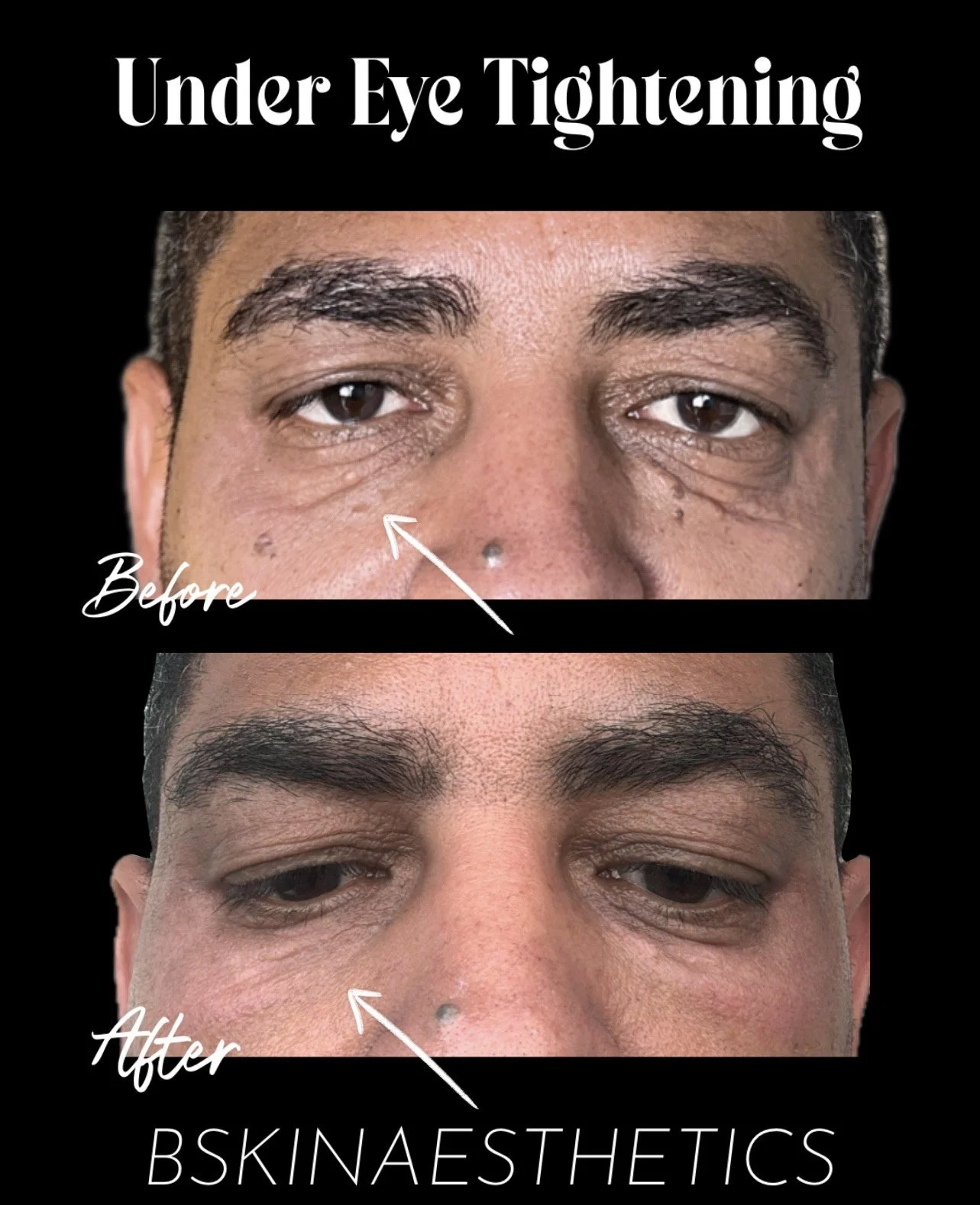 Anti Aging Skin Elasticity Under Eye Area