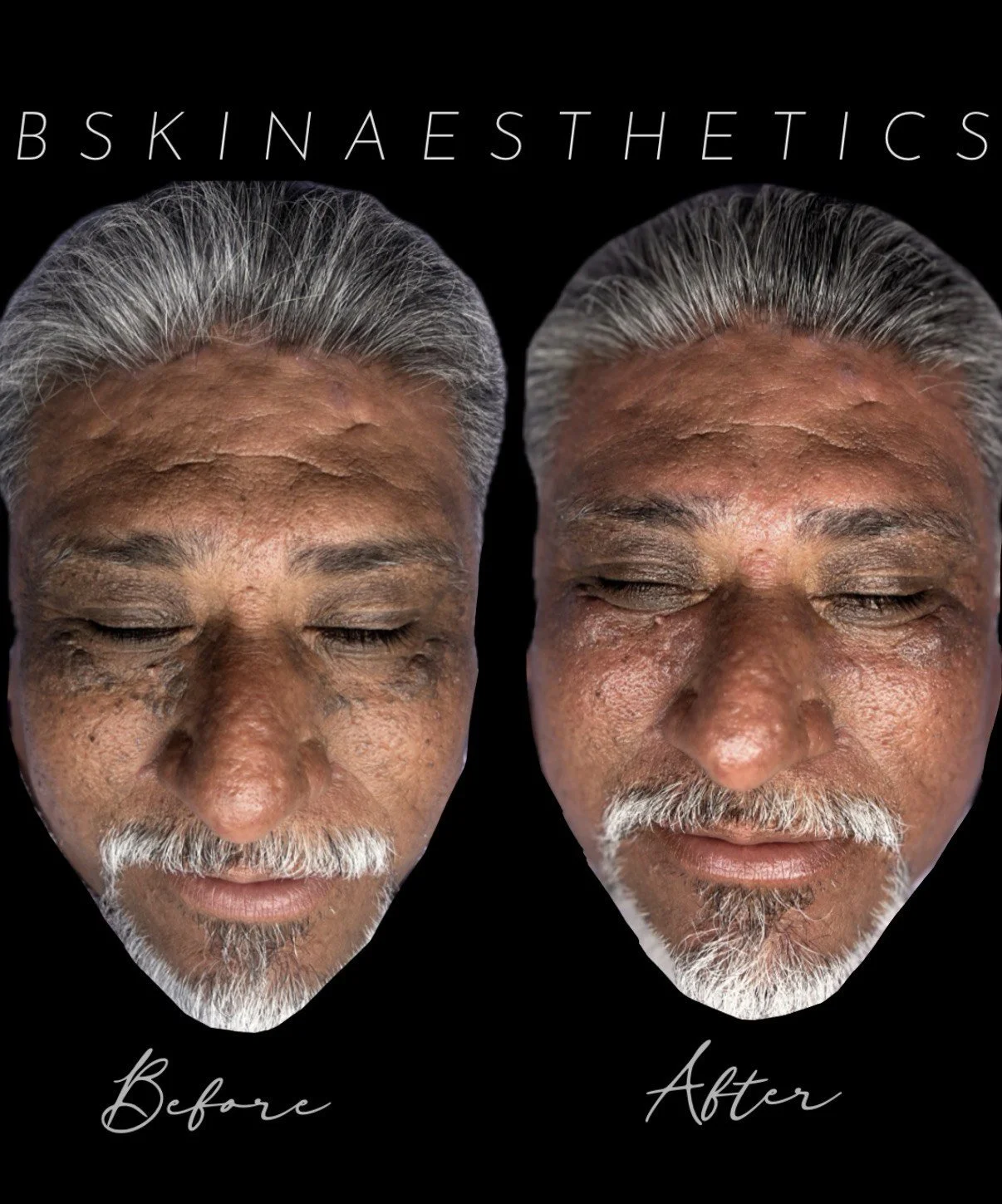 Personalized Facial with Extractions