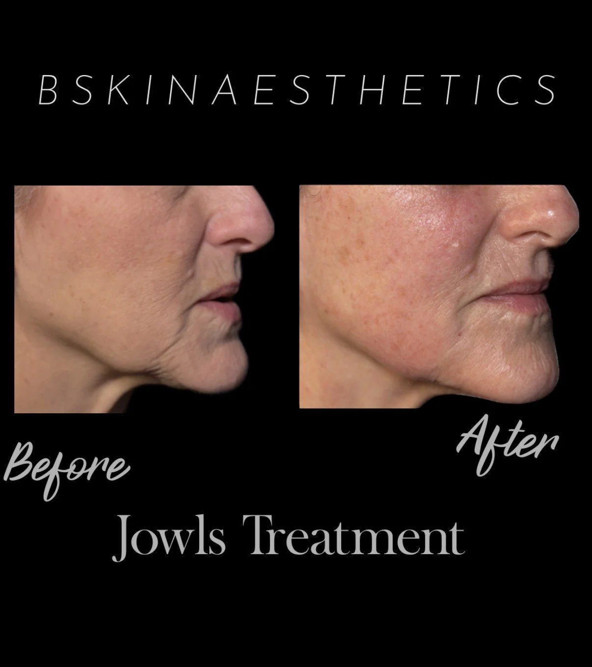 Jowls Treatment with Filler