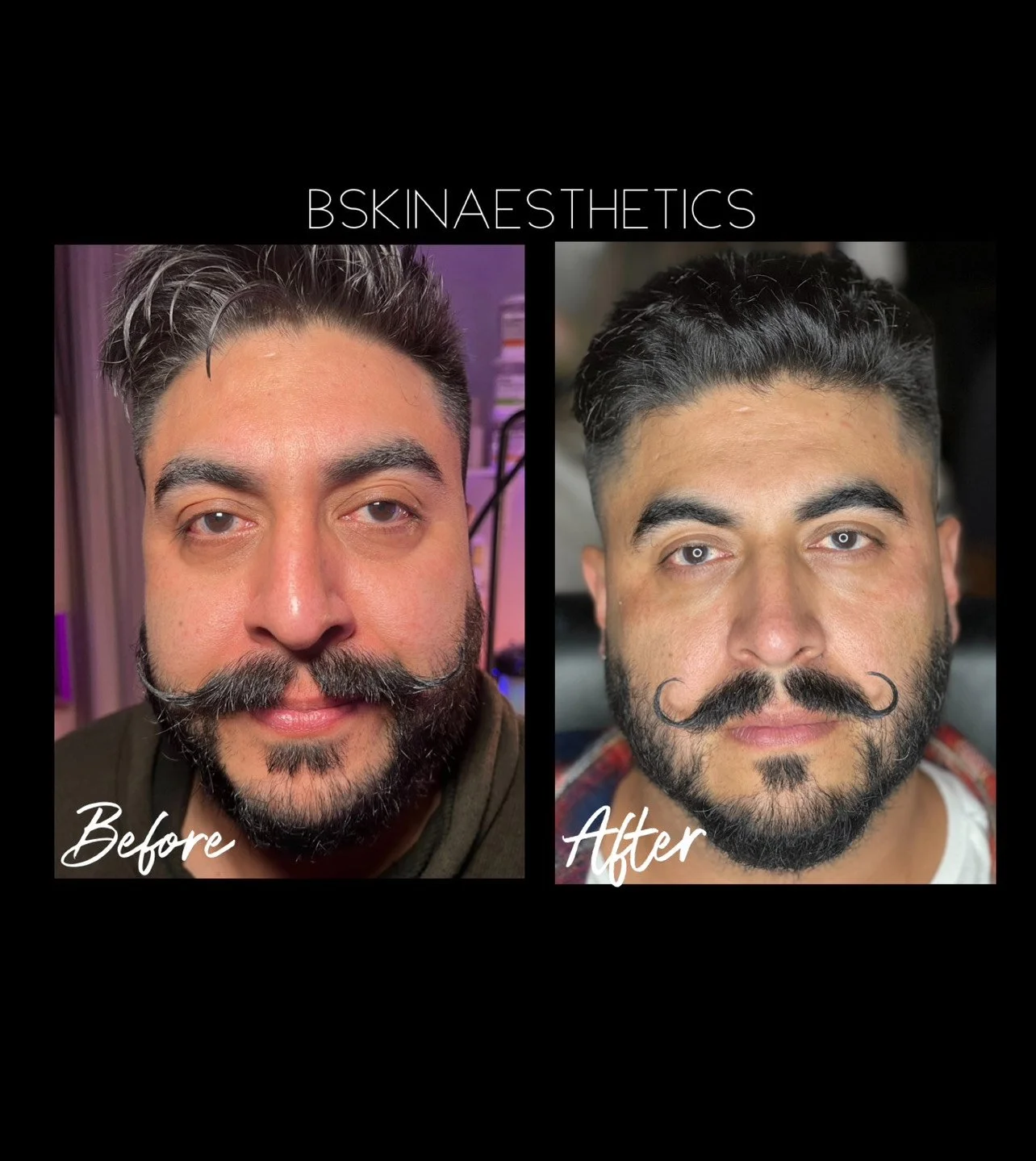 Tear Through Filler, Botox, Nose, Cheek Filler, Lateral Tear Through 