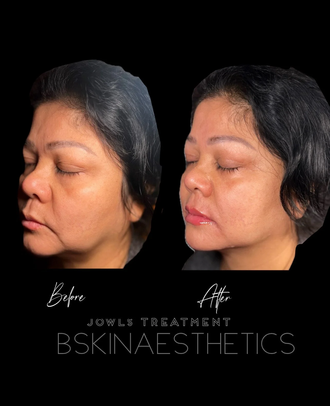 Jawline Filler , Lip Touchup 