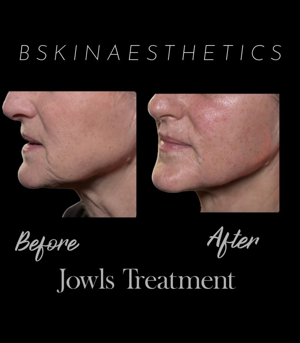Jowls Treatment with Filler
