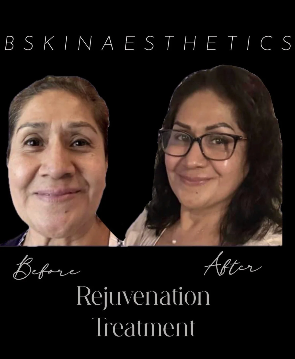 Botox, Cheek Filler, Lip Hydration, Tear Through Filler, Multiple Advanced Facial Treatments 