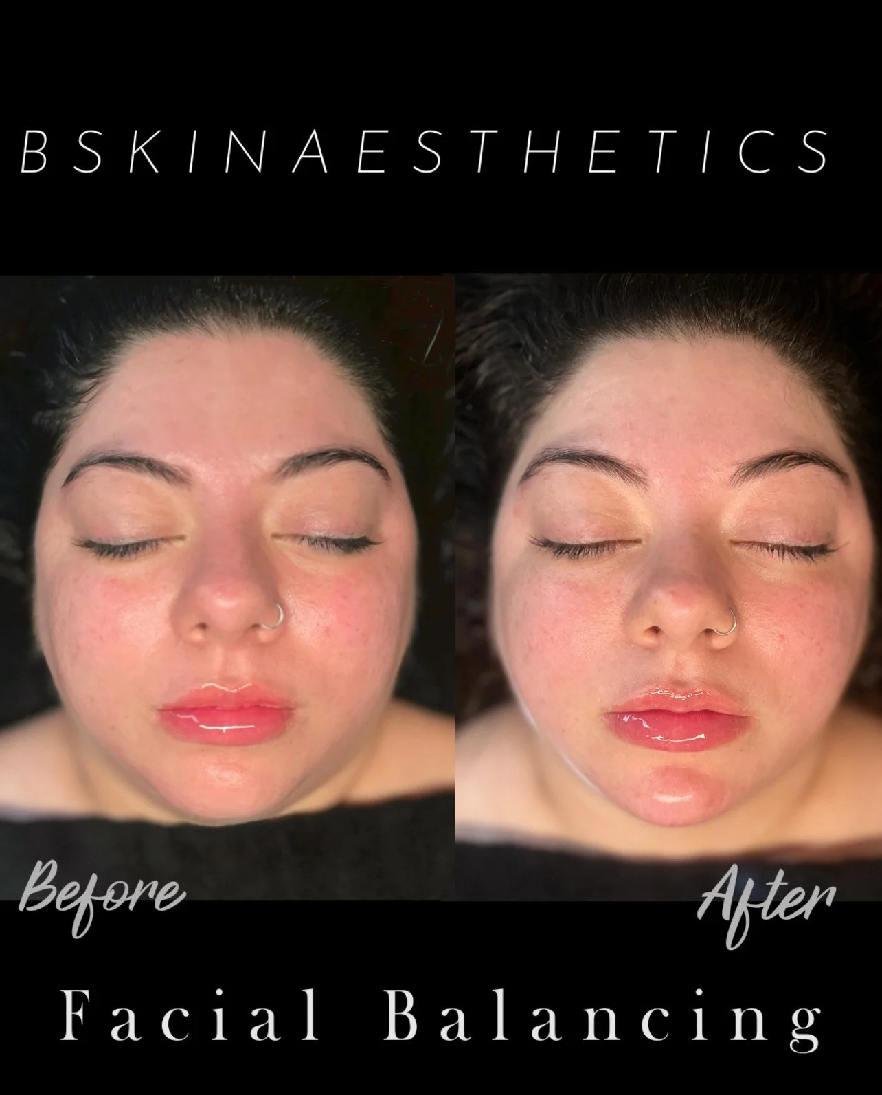 Personalized Facial for skin oxygenation, Chin Filler (Phase One )