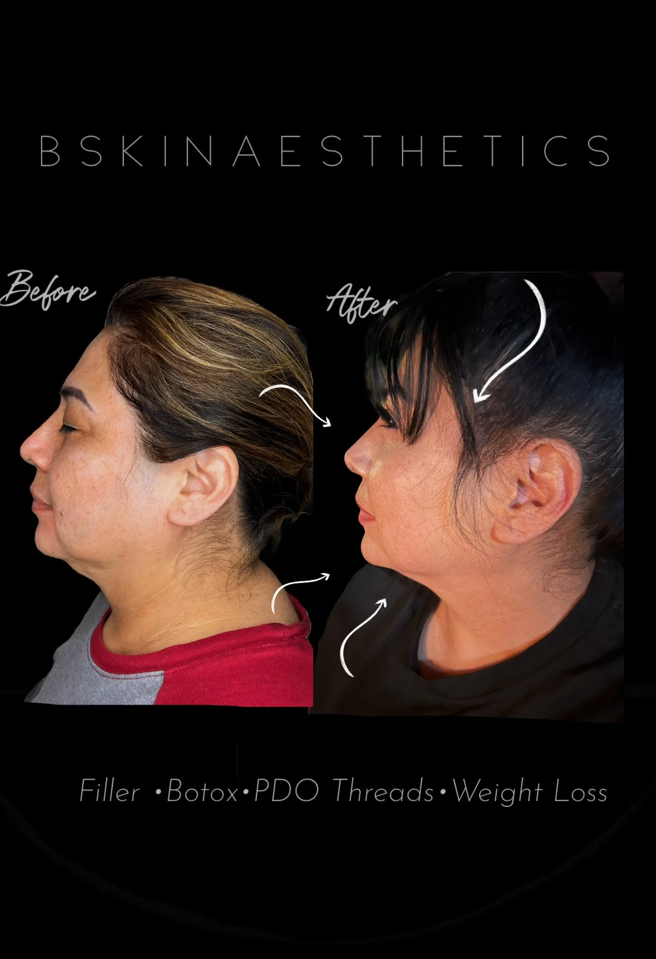 Chin Filler, Nose Refinement, Tear Through Filler