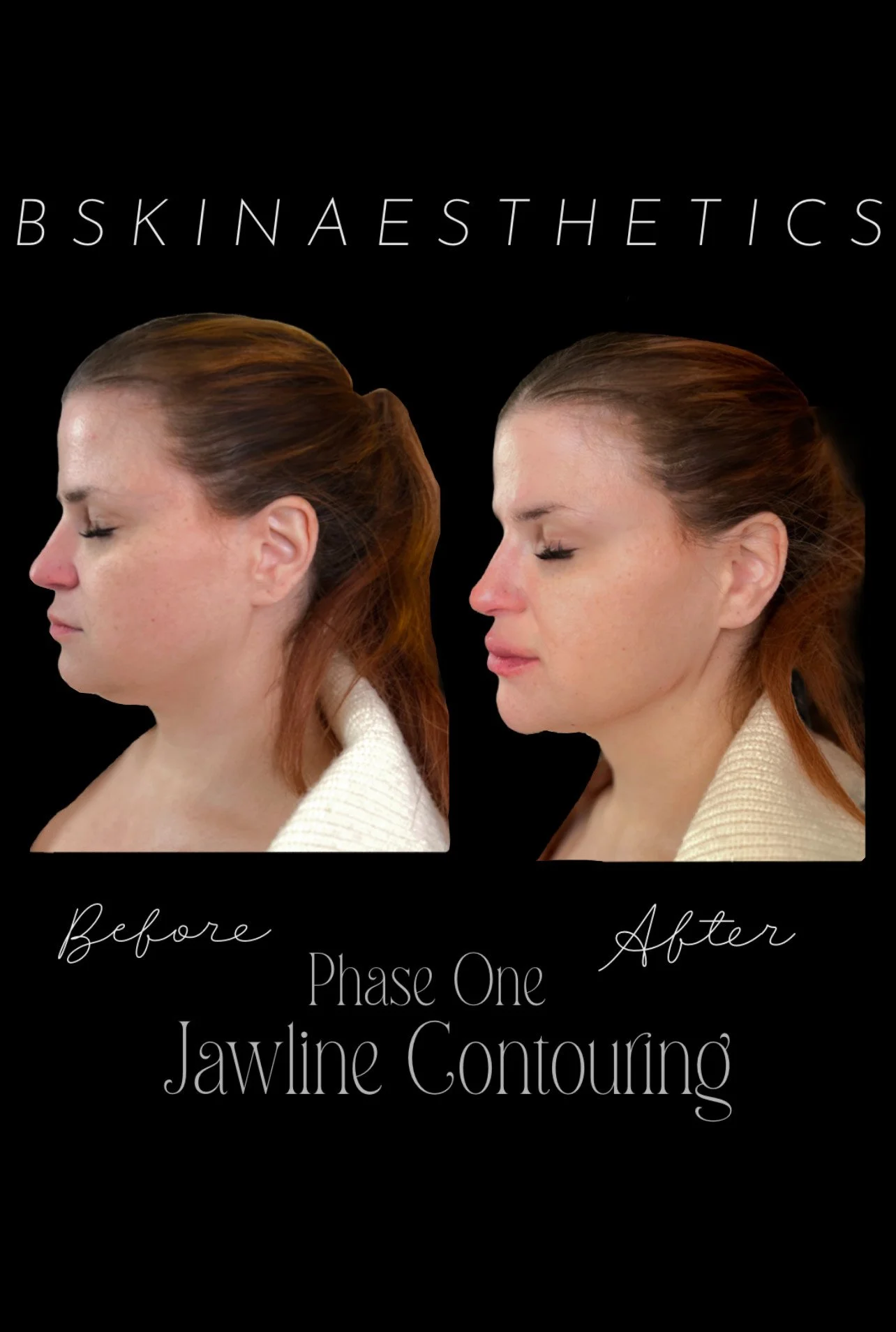 Jawline Filler, Lip Filler