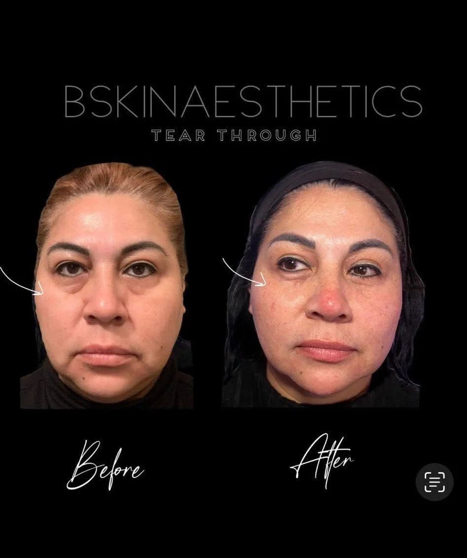 Tear through Filler, Botox 