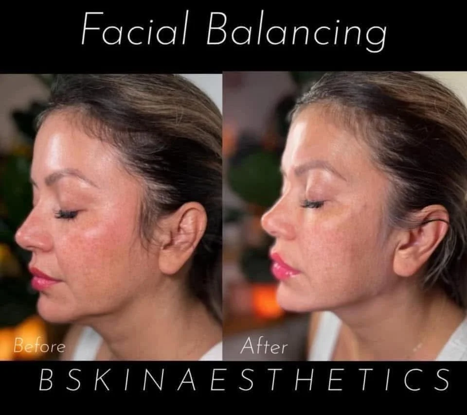 First Session Jawline Contouring | Nose | Lips