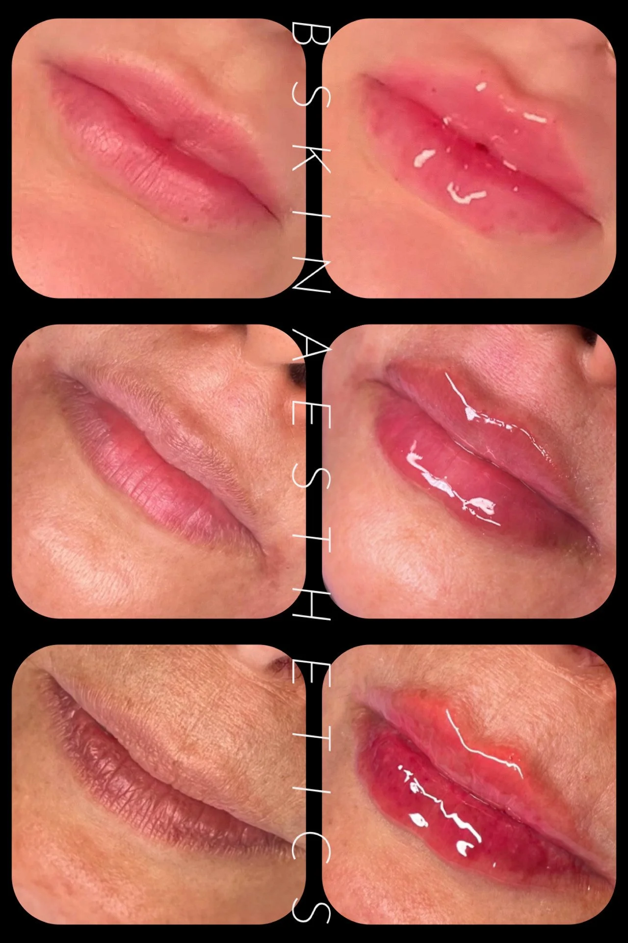 Lips Before & After Maintaining Shape as priority. Bottom Lips - Lip Hidration