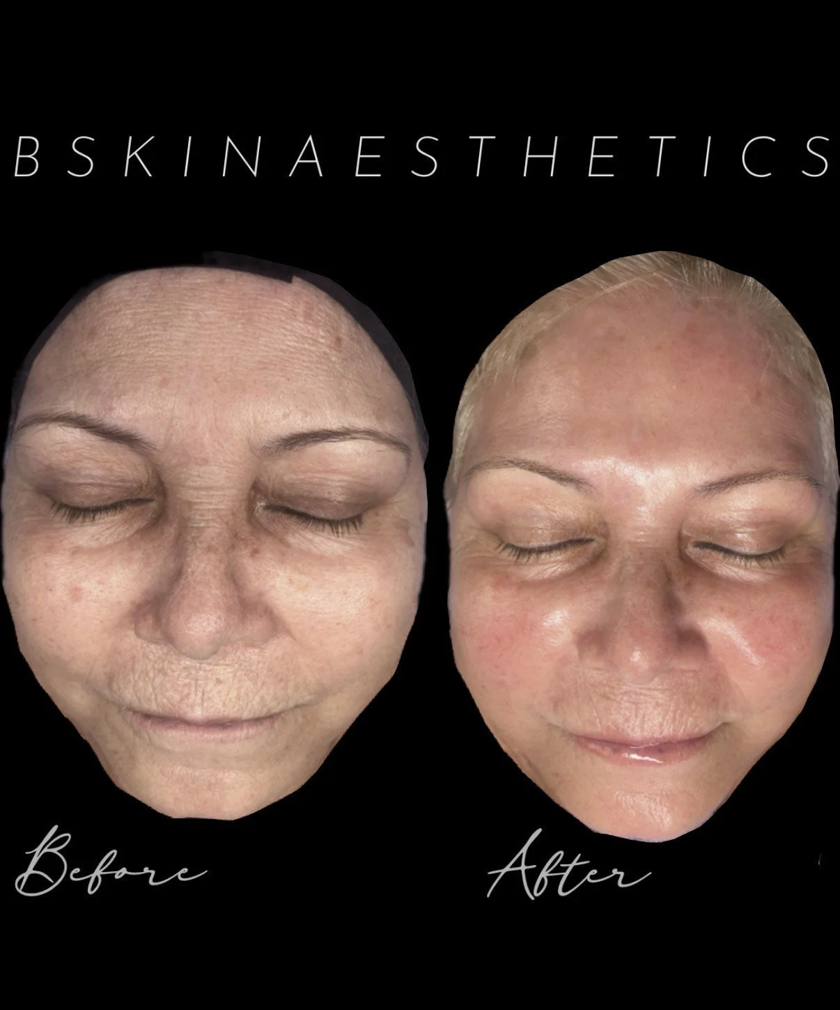 Post Advanced Facial Treatments for Elasticity, Rejuvenation, and Collagen