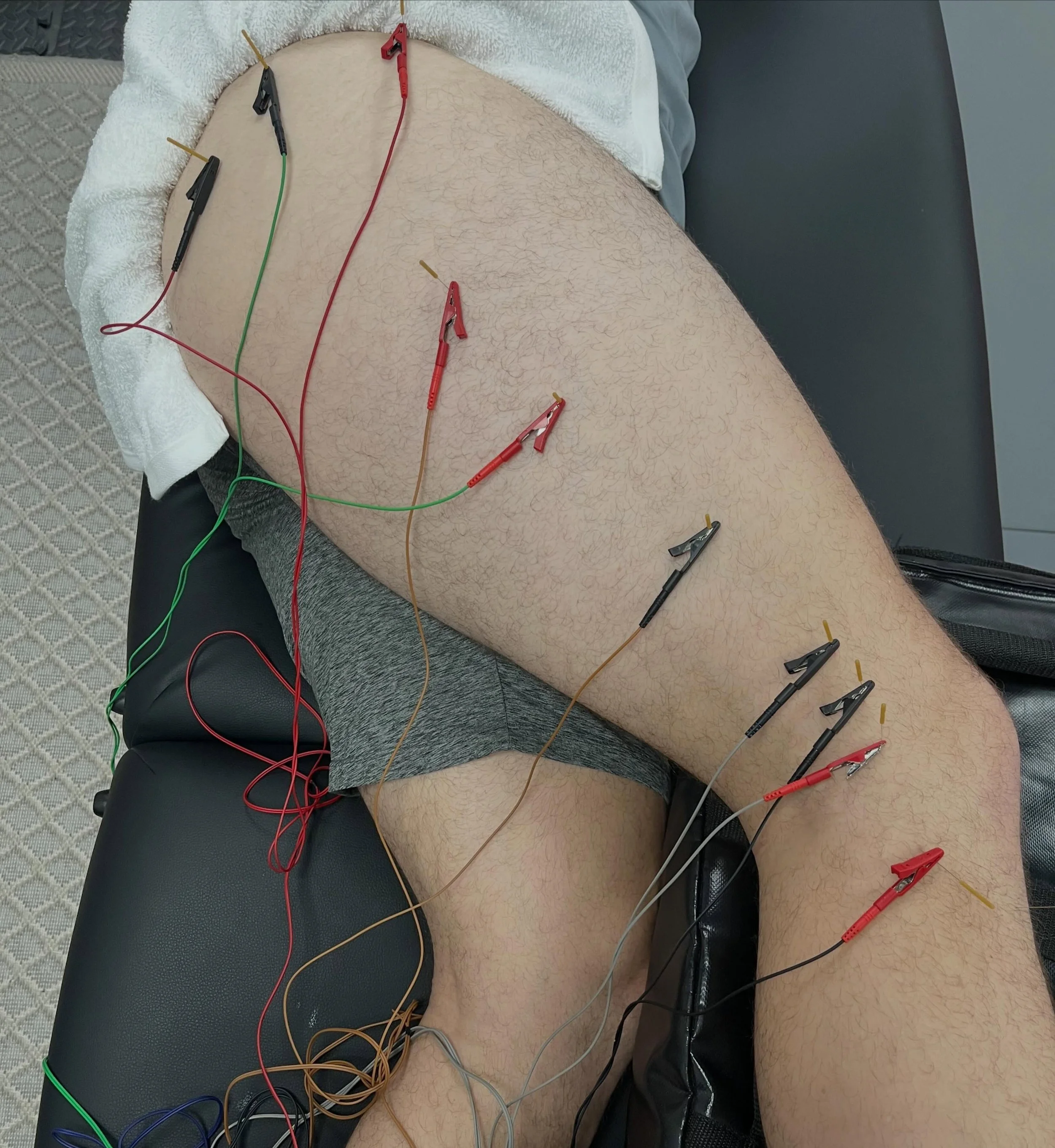 Are you tired of being told you just need to &ldquo;get stronger&rdquo; to solve pain? There is often much more going on with pain than simple weakness.

This patient had been complaining of knee pain which lasted for years after a lateral knee strai