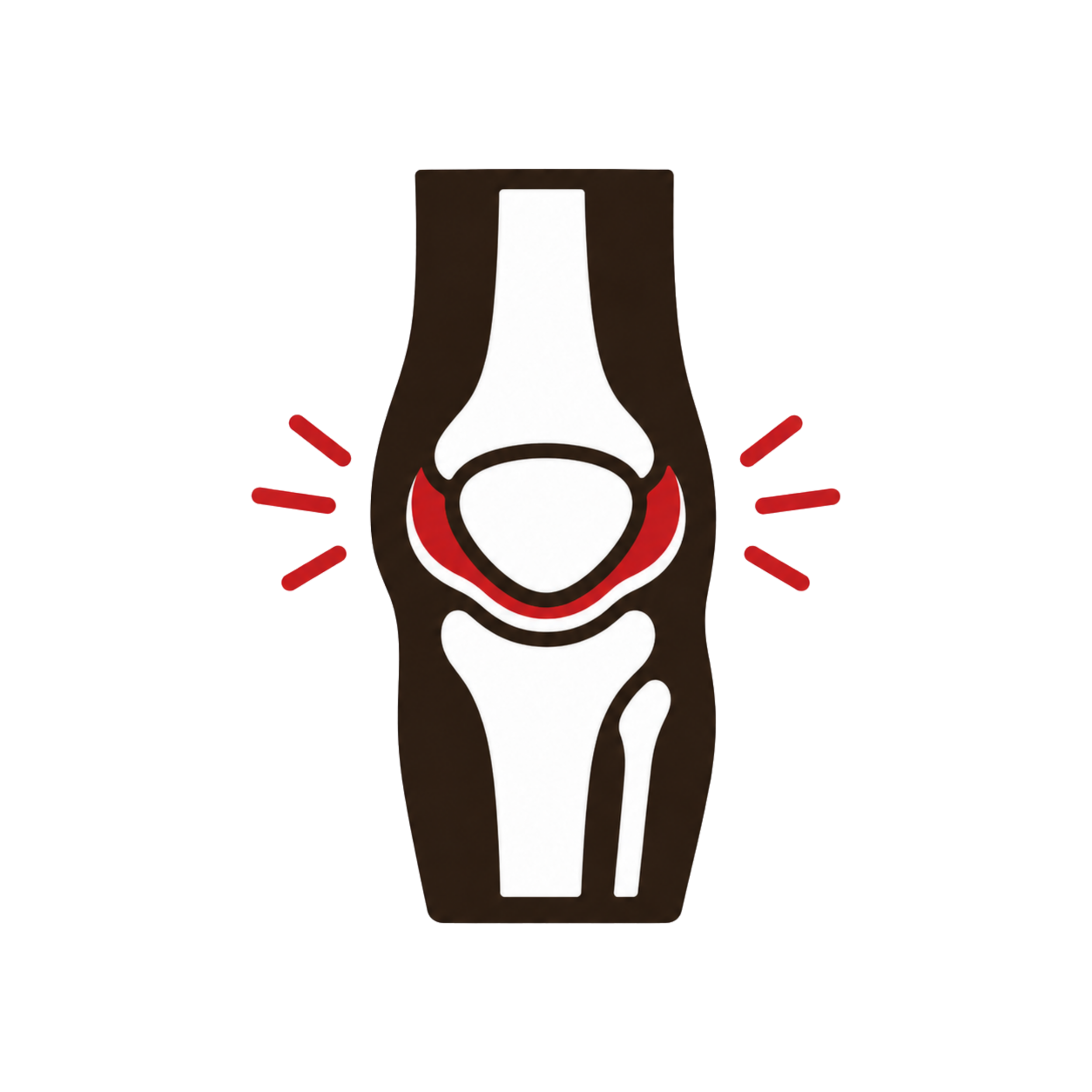 Patellofemoral Pain Syndrome (Runner's Knee)