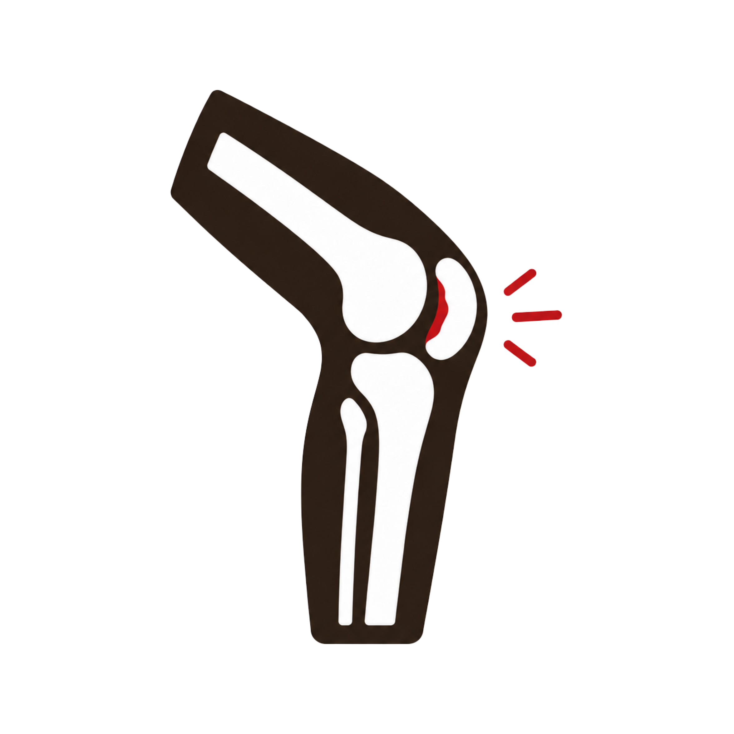 Chondromalacia Patellae