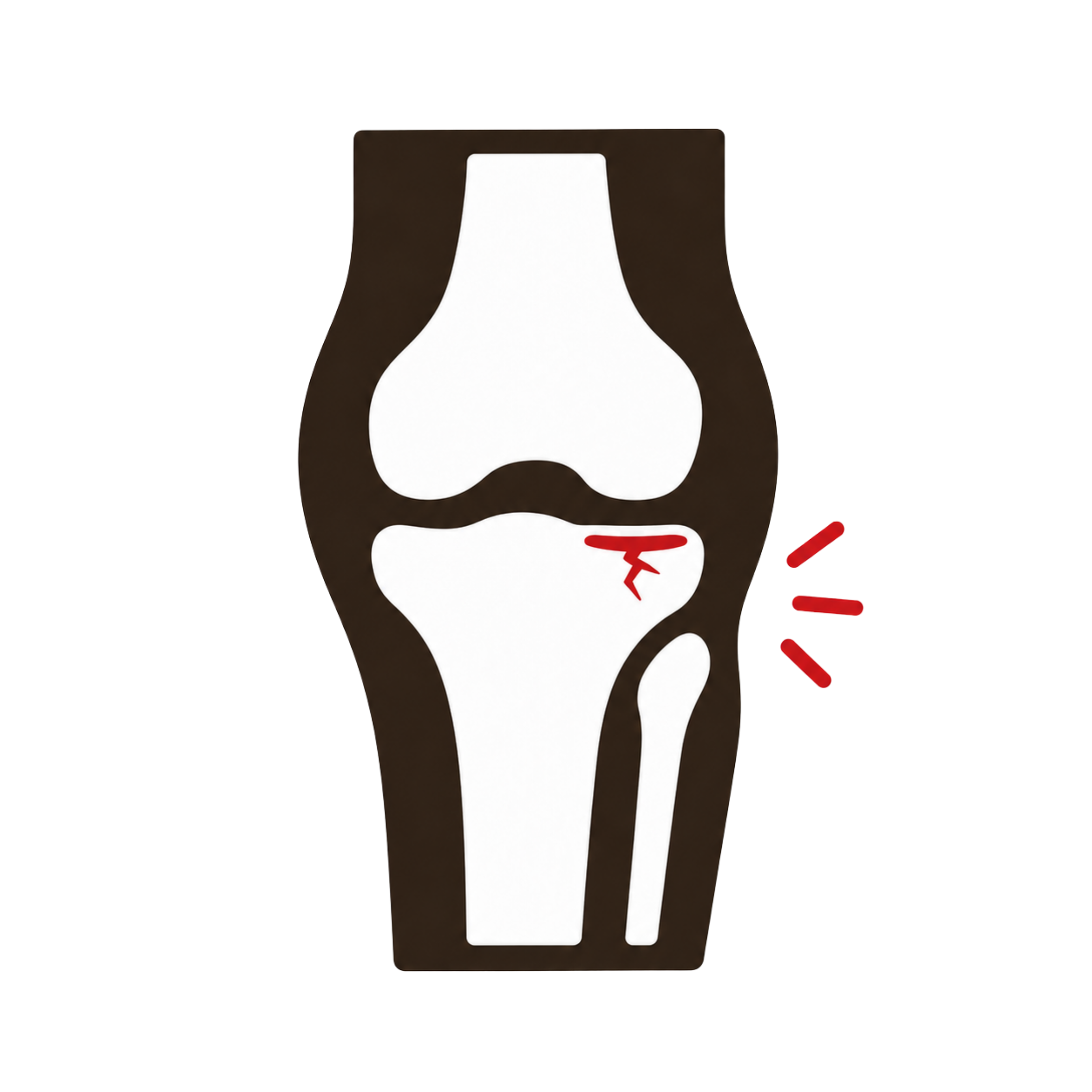 Tibial Plateau Stress Fracture