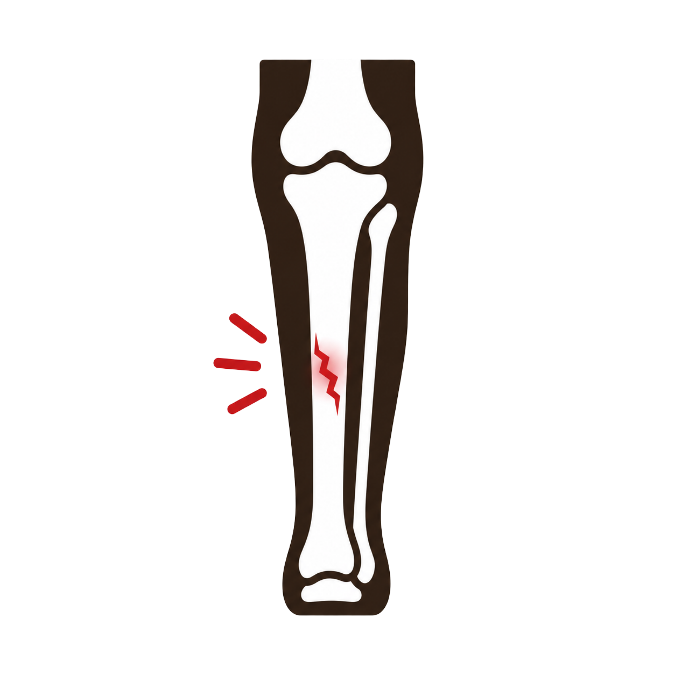 Tibial Stress Fractures