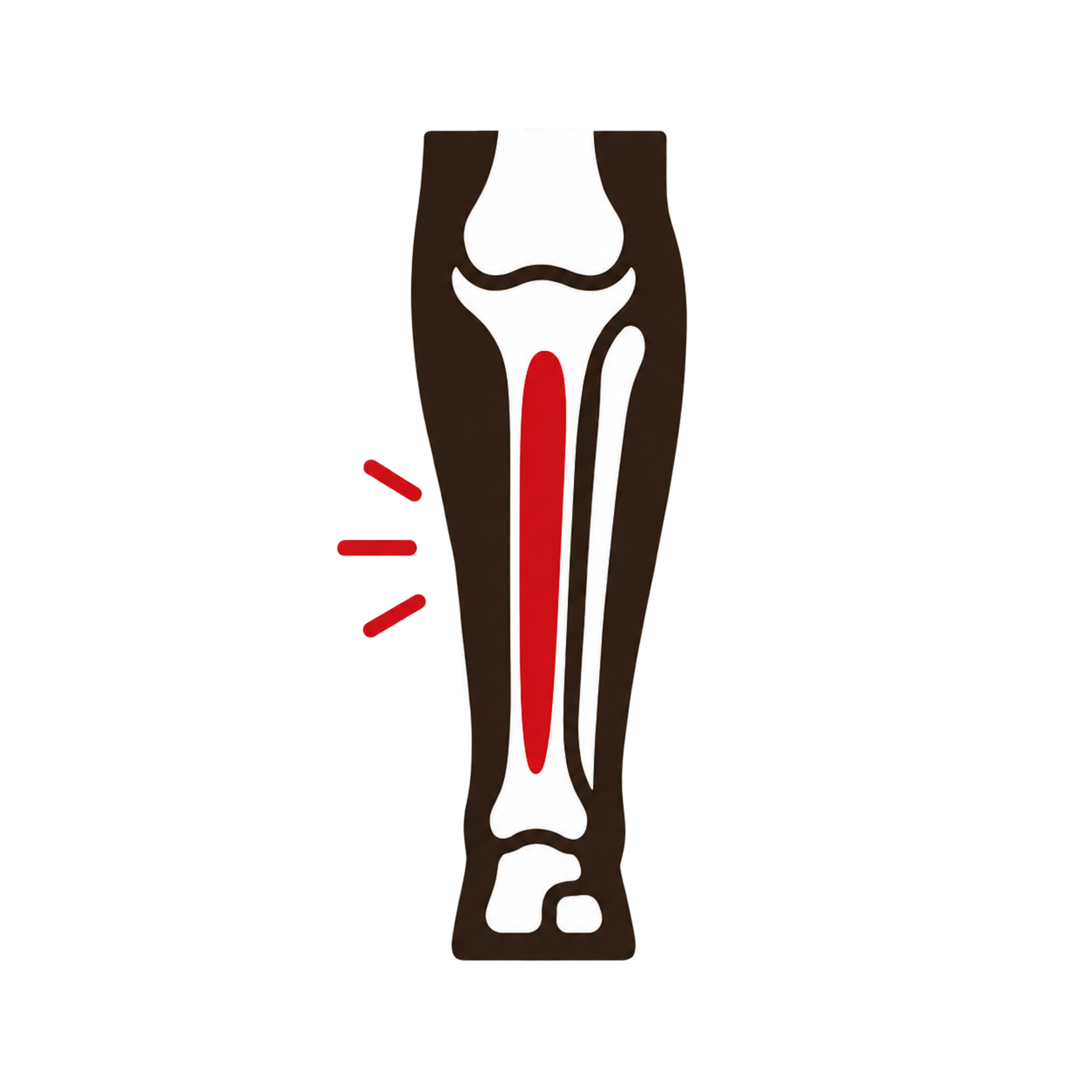 Shin Splints (Medial Tibial Stress Syndrome)