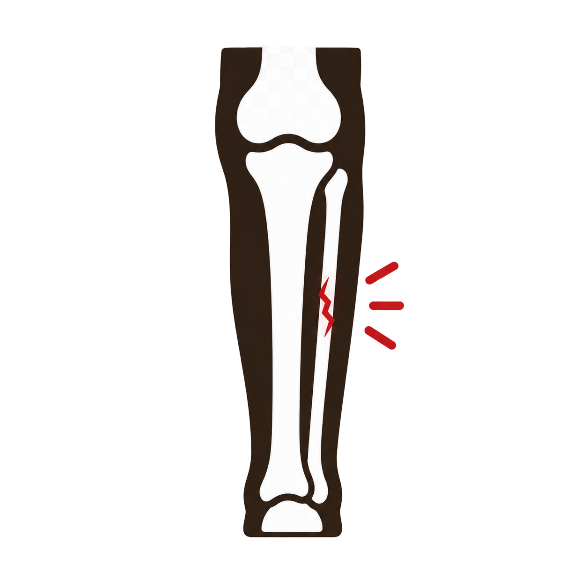 Fibula Stress Fractures