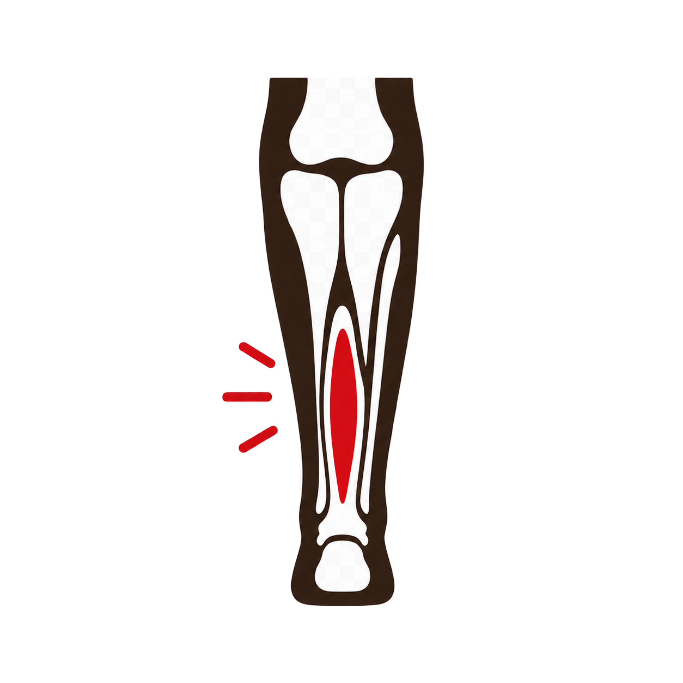 Soleus Strain