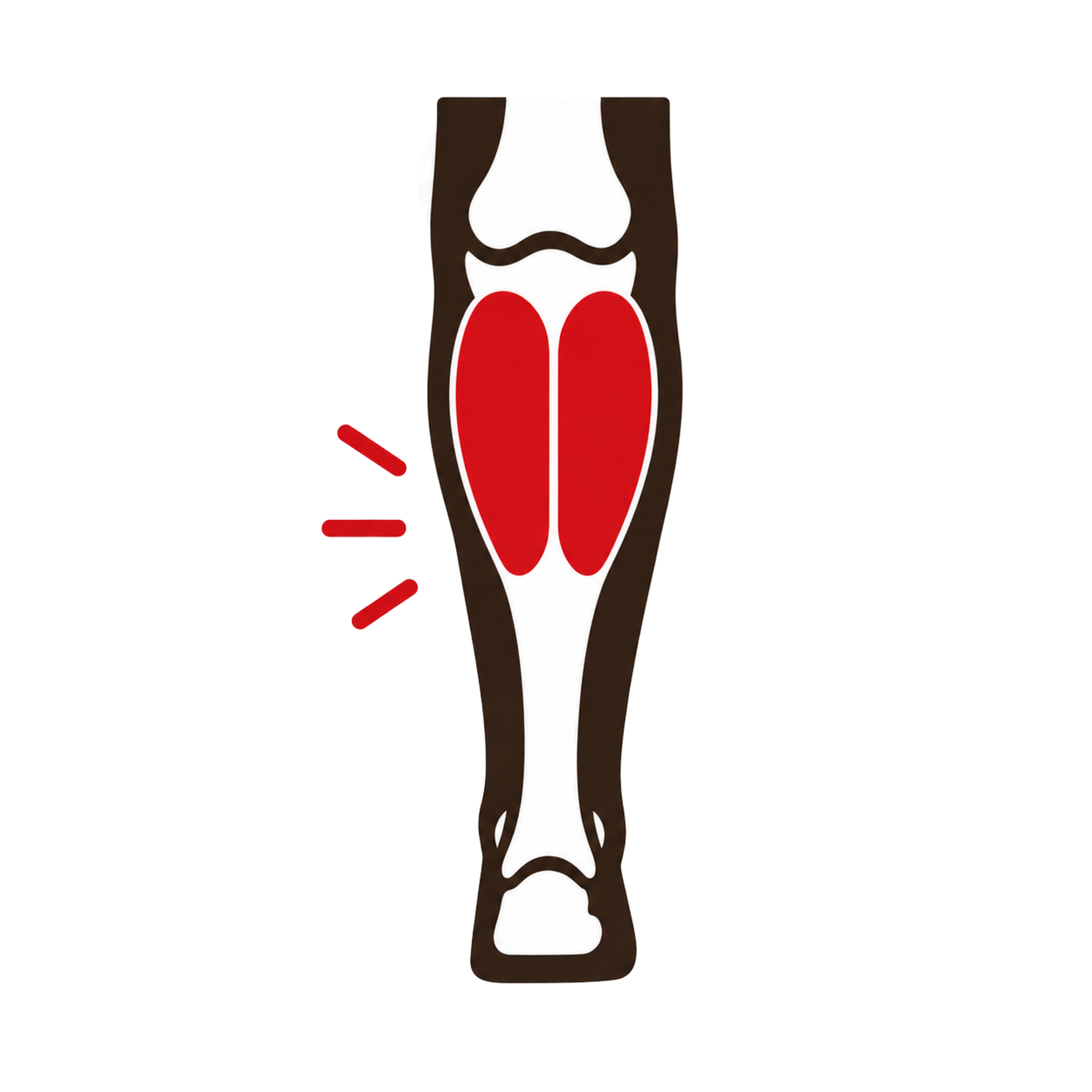 Gastrocnemius Strain (Calf Strain)