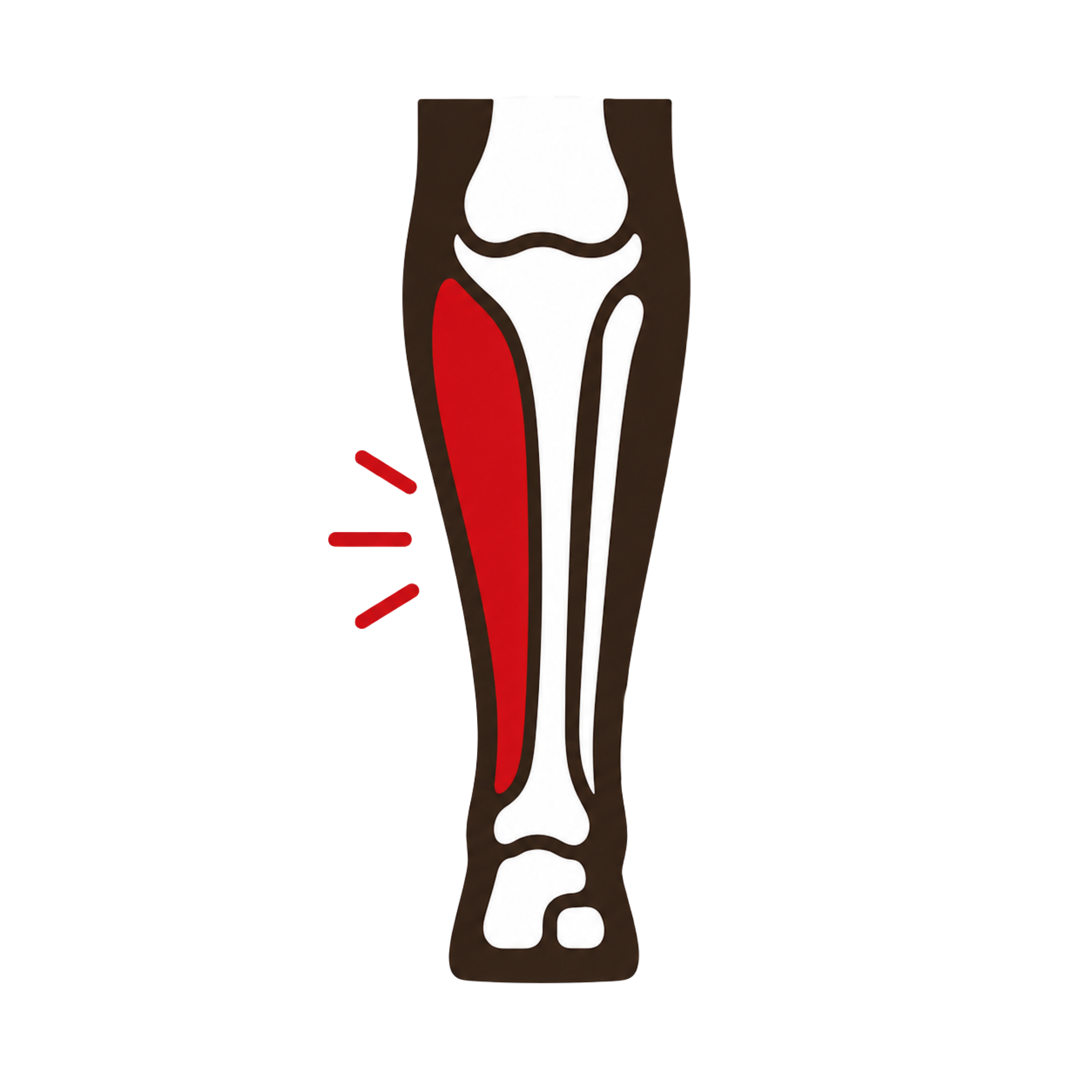 Chronic Exertional Compartment Syndrome (CECS)